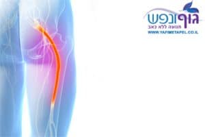 הקרנה לרגל עקב סיאטיקה - sciatica