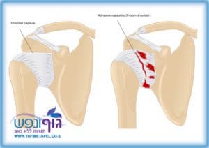 כתף קפואה frozen shoulder