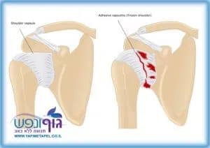 כתף קפואה frozen shoulder