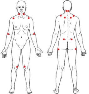 תסמונת פיברומיאלגיה