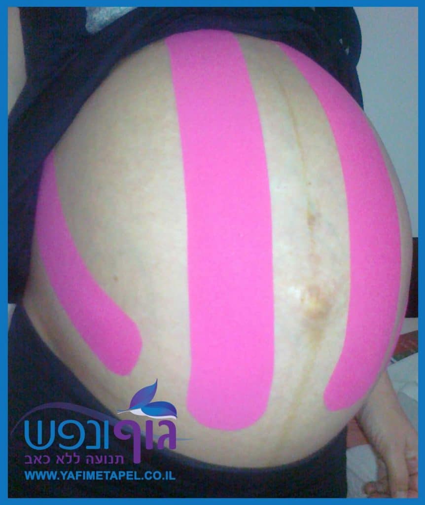 טיפול עם שימוש בקינזיו טייפ בתקופת ההיריון