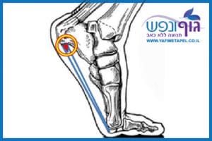 דורבן בעקב ודלקת בפסיה הפלנטרית