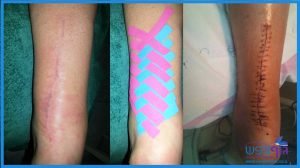 טיפול לאחר ניתוח עקב קרע בגיד אכילס