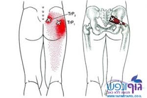 תסמונת פיריפורמיס - piriformis syndrome
