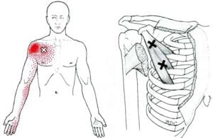 כאב מוקרן מנקודות טריגר בשריר החזה