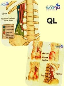 תרשים שמראה את שריר הקוודרטוס לומבורום בין רכס האגן לצלע 12 בצד עמוד השדרה המותני