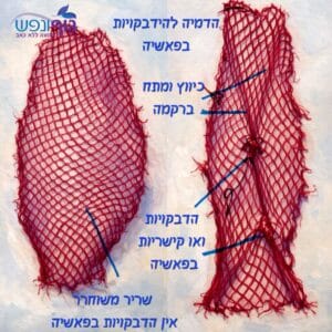 הדמיה של שכבות פאשיה וצלקת לאחר ניתוח והחזרת החלקה בין שכבות